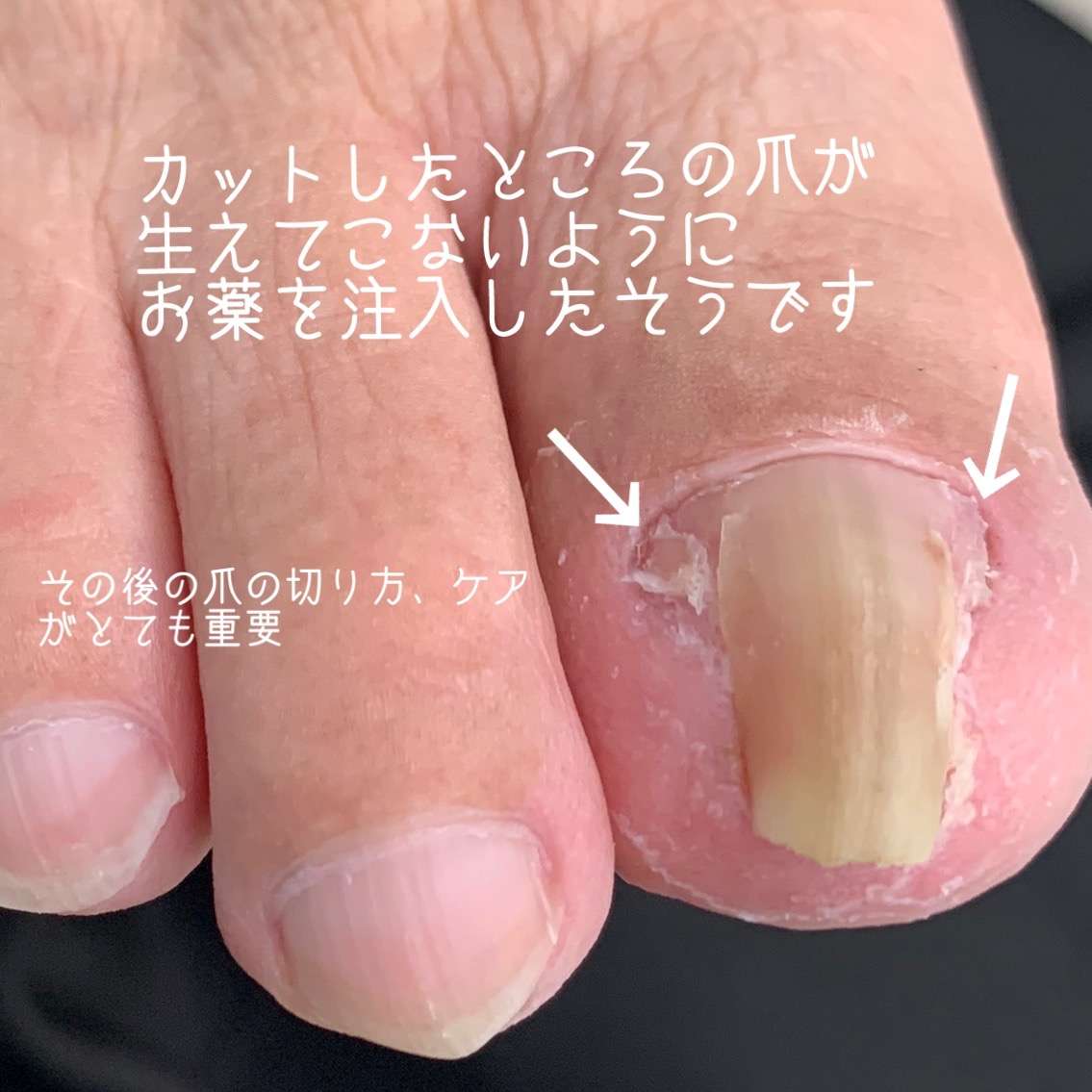 巻爪緩和に♪陥入爪の方にも◎