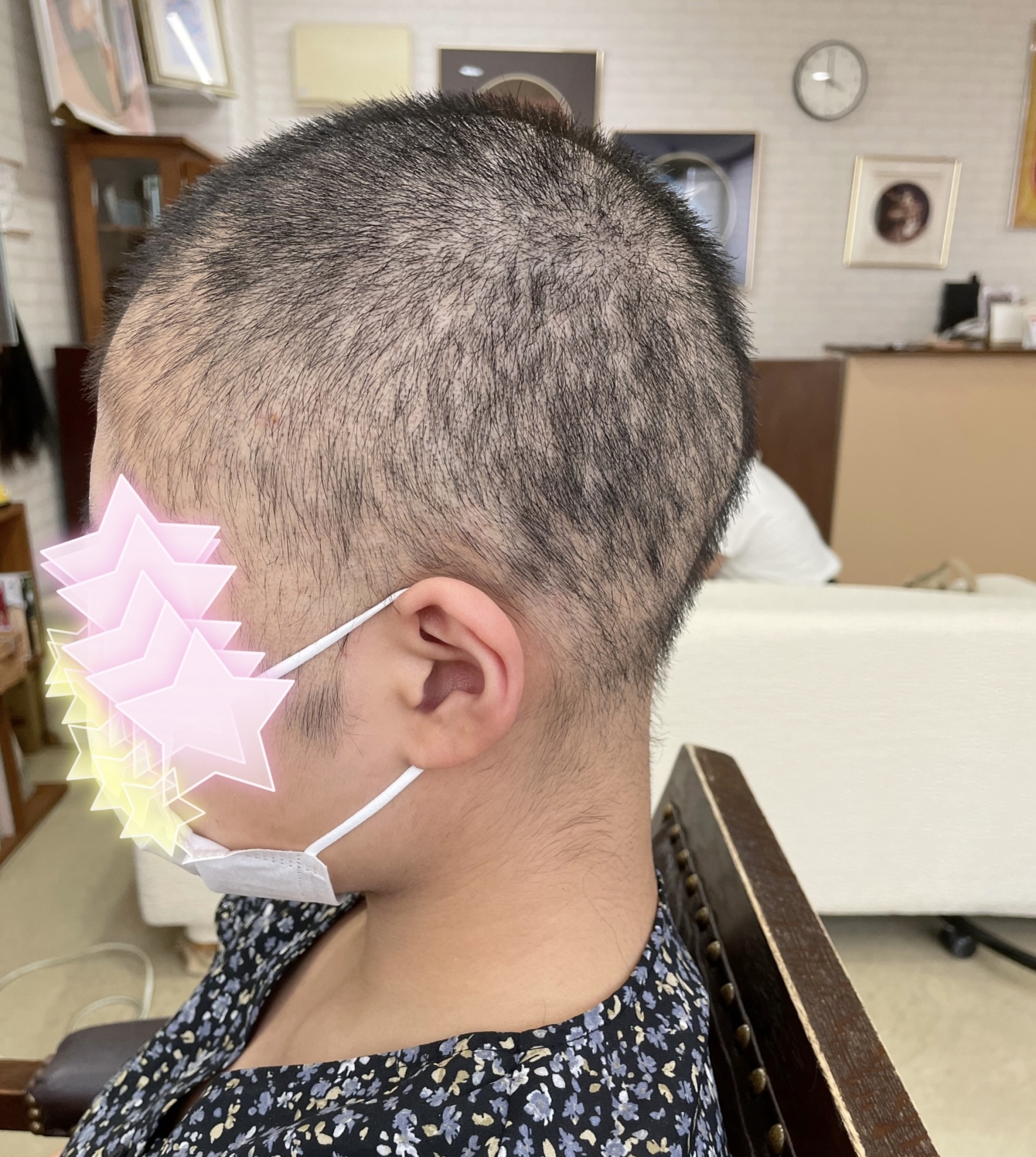 髪の毛の一般的な１日の抜け毛本数は何本なのか？池袋AGAクリニックで発毛治療