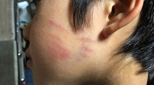 咬傷 : ページ1モイストブログ