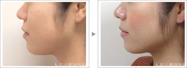 3日で効果ある顔痩せマッサージの続編🌟 顔痩せ筋トレ方法と小顔マッサージ紹介！TikTok