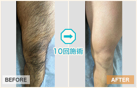 男のすね毛脱毛＆処理方法5つ！薄くするムダ毛の剃り方からメンズ永久脱毛まで徹底解説The Style Dictionary