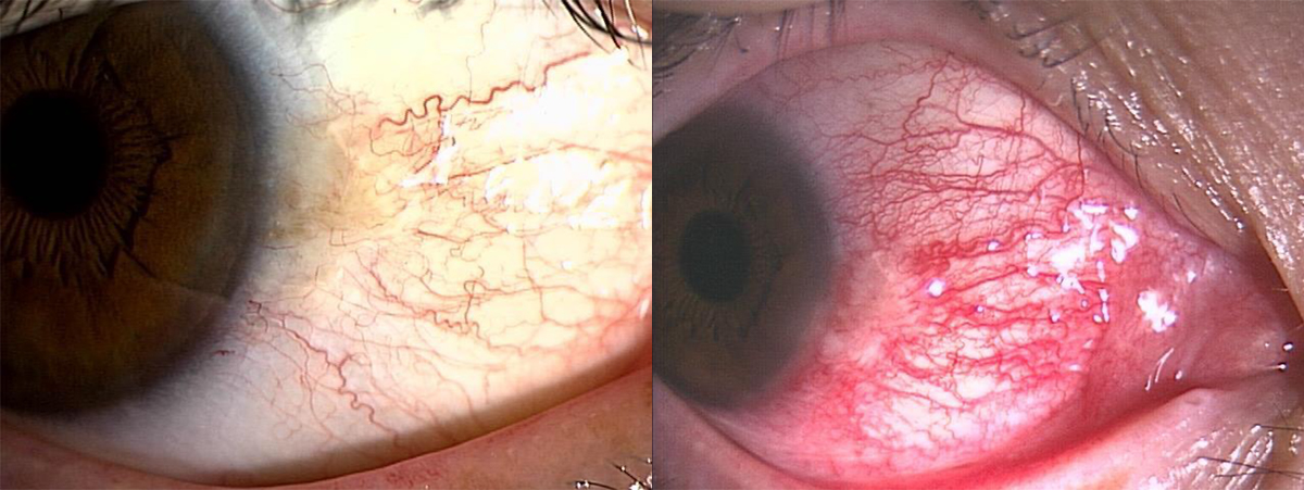 カラコンで目が真っ赤!?充血の原因と充血を治す7つの方法モアコンタクト モアコン 公式カラコン通販