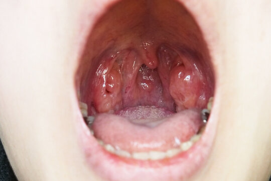 溶連菌感染症 ようれんきんかんせんしょう 目で見てわかる子どもの病気子どものホームケアの基礎