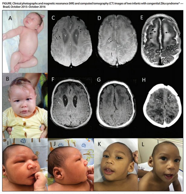 ヘルメット治療をするにあたって覚悟すべき4つこと ヘルメット治療体験談短頭＋斜頭 ：Rくんヘルメット治療ならスターバンドのAHS Japan