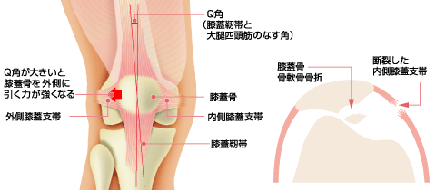 扁平足とは？扁平足の治療と予防天神橋筋六丁目 天六 駅の整形外科天6整形外科