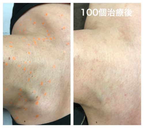 浦和でイボの治療ならあきもと皮フ科クリニック