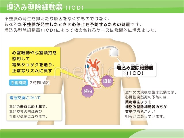 植え込み型除細動器 - 心臓血管センタ