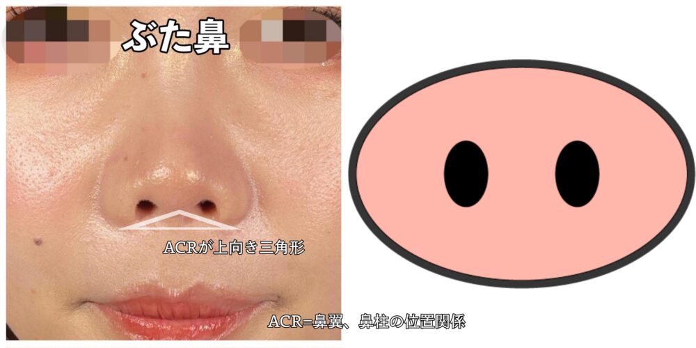 団子鼻やにんにく鼻を自力で治す方法は？おすすめのマッサージを紹介美容整形はTCB東京中央美容外科