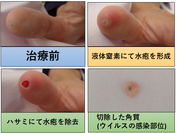 足裏の大きく治療困難なウイルス性いぼ大和駅前いなば皮膚科 旧名：大和駅前皮フ科スキンクリニック