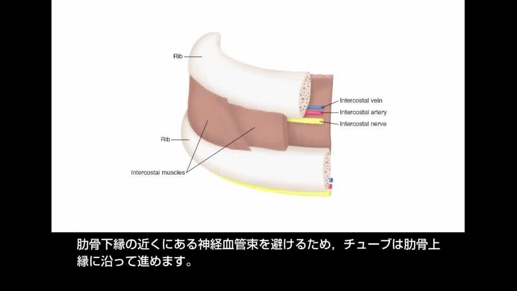 胸腔ドレーン １目的と挿入部位見て！わかる！病態生理と看護 花子のまとめノート