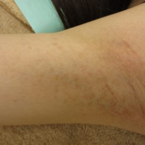 脇のブツブツの治し方とは？白い・赤い・黒いブツブツの正体も解説ハダメディア by BIHADADO.TOKYO