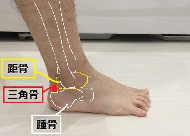 ハグルンド病 かかとの後 の原因 症状 治療法をプロが徹底解説