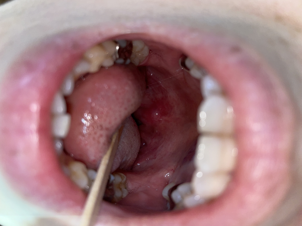 扁桃腺がはれている？？？西宮のわしお耳鼻咽喉科