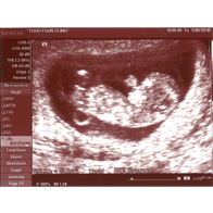 妊娠中のエコー写真21枚で指摘できる、ダウン症の予兆東京・ミネルバクリニック