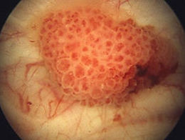 対象となる病気 膀胱がん診療紹介金沢医科大学 泌尿器科学