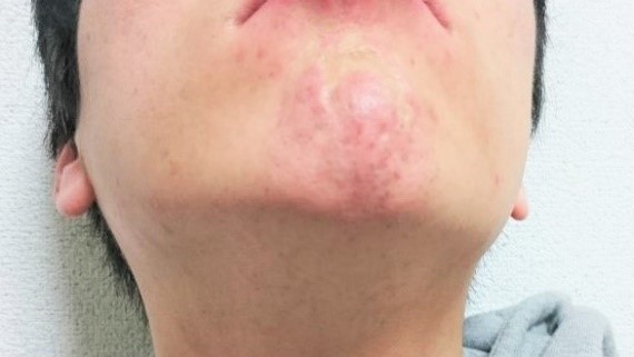 コロナ後遺症で円形脱毛症？ オミクロン陽性者にワクチンは？ 感染拡大で広がる“噂”に医師が回答 2ページ目週刊女性PRIME