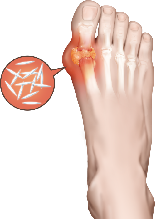 痛風ヘルスケア情報薬と健康を見つめる製薬会社 佐藤製薬株式会社