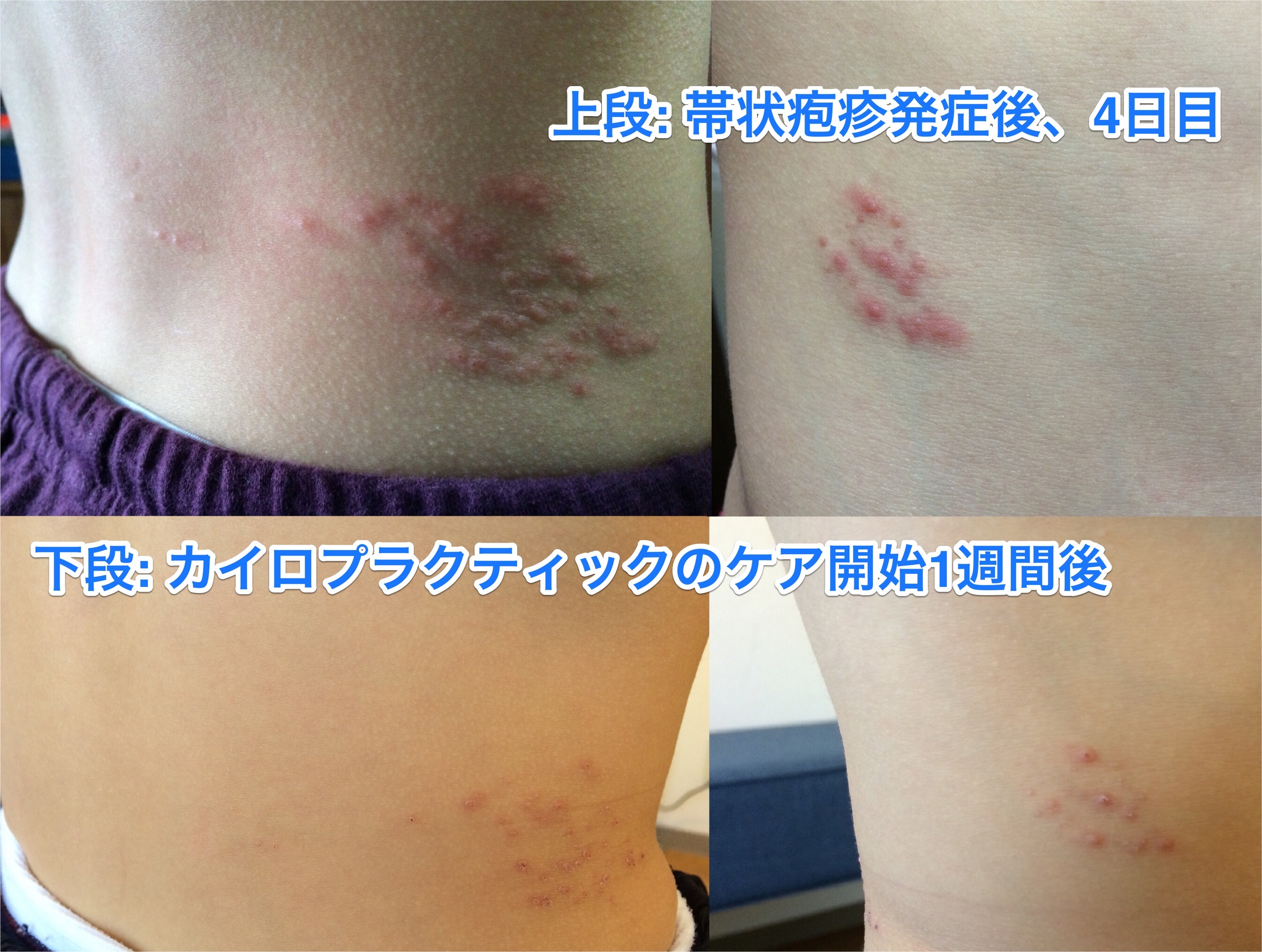 帯状疱疹後の神経痛 残さない方法は？ 治療始める早さがカギ ５０歳以上はワクチンも 文化・くらし 山梨さんにちEye 山梨日日新聞デジタル