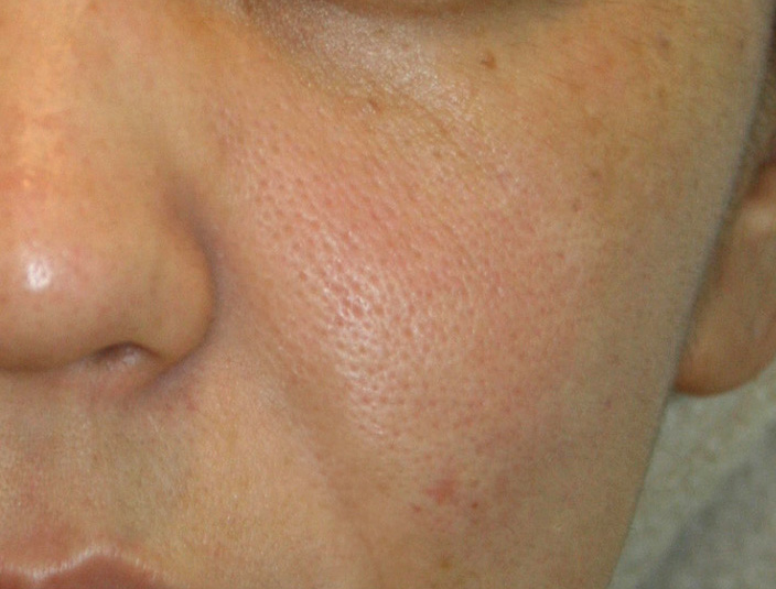 40代のたるみ毛穴改善原因とおすすめ治療 医師監修- 新宿の美容外科・美容皮膚科ならPonoクリニック