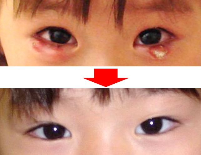 まぶたが腫れたなえ眼科クリニック海老名