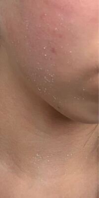 洗顔後に現れる「白いポツポツ」は角栓！取り方とおすすめスキンケア紹介