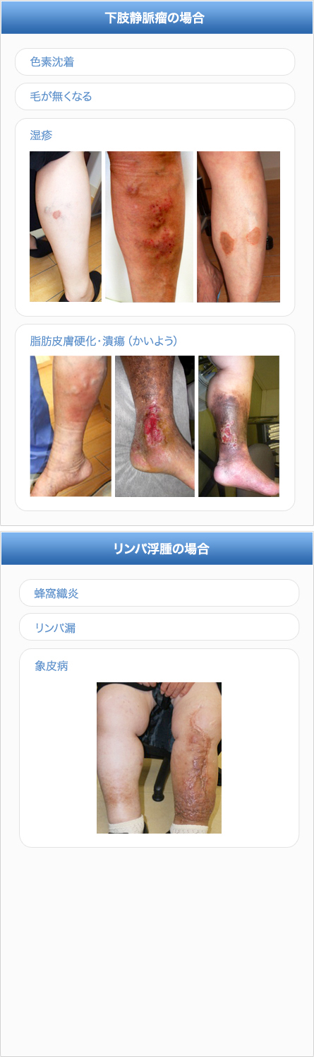 若い女性に多い「秋のむくみ」 その正体は「好酸球性血管性浮腫」かもしれません森嶋クリニック