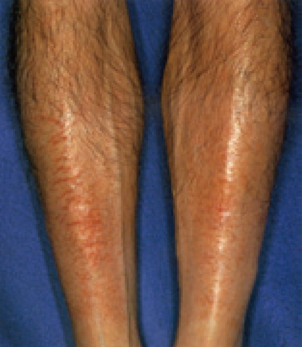 乳児の乾燥性湿疹の原因と症状とは？スキンケア方法も伝授します！ - HISAKOホーム