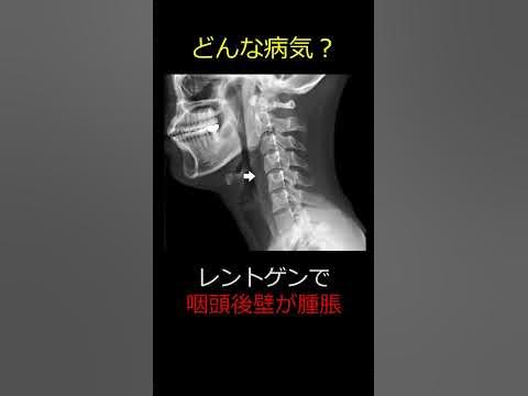 Crowned dens syndrome と石灰沈着性頸長筋腱炎