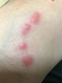虫刺され高田馬場皮膚科・形成外科