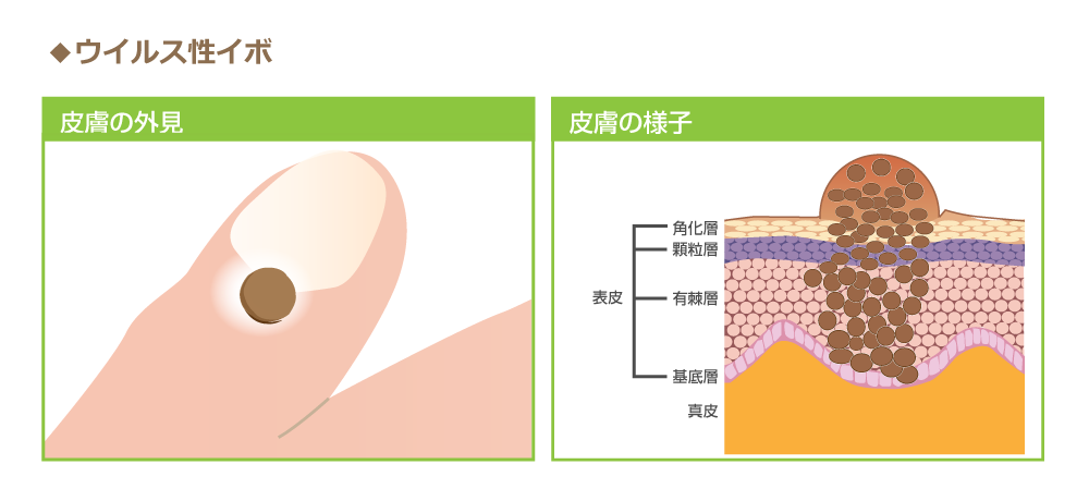 イボはどうしてできる？原因や種類の違いは？おすすめの治療方法新宿美容外科クリニック 公式