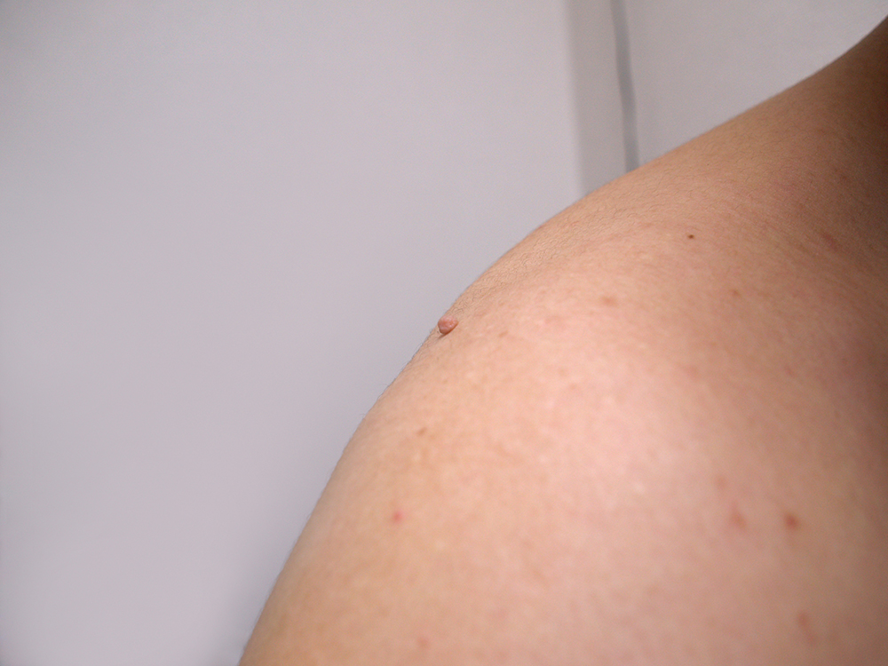 大きなはたけができました💦の写真・画像素材-Snapmart スナップマート