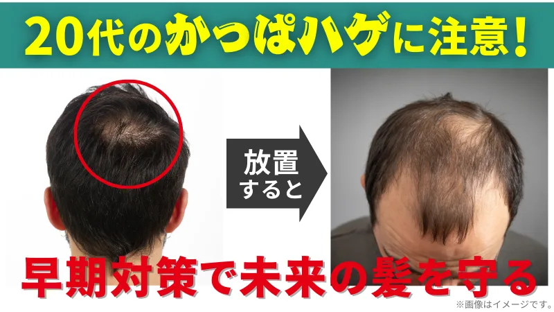 M字はげは治らない？間違った対策と正しい治療法を解説 - 湘南AGAクリニック大宮東口院-AGA治療・薄毛治療・自毛植毛