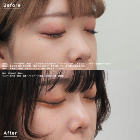 外傷性斜鼻の患者様の治療経過のご紹介です。 以前受傷した鼻骨骨折によって外傷性斜鼻となった30代前半の男性です。 外鼻の変形と、鼻腔通気障害の御相談でいらっしゃいました。鼻背を真っ直ぐにして、鼻の通りを良くしたいという御希望が御座いました為、整容性と機能