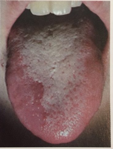 淡紅舌 - ひぐち歯科、口腔外科・口腔内科メディカルインフォメーション