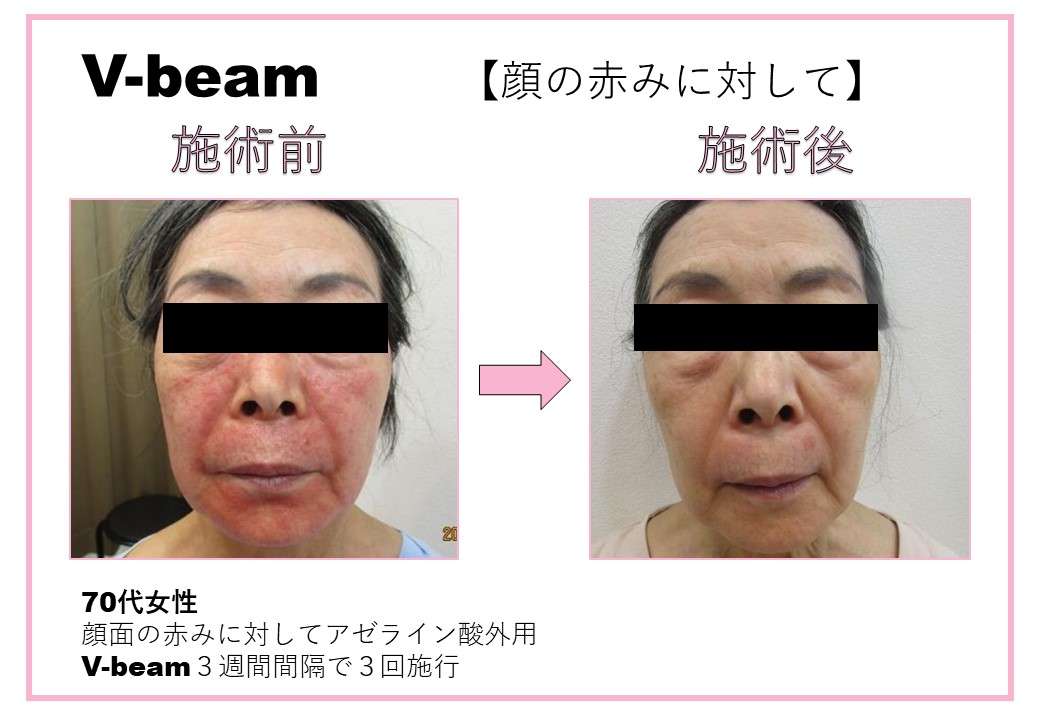 すっぴん時の顔が赤い原因とは？美容医療で改善できる