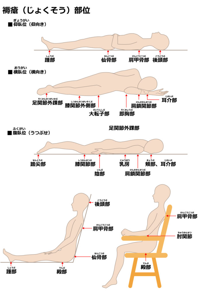 褥瘡について – 医教コミュニティ つぼみクラブ
