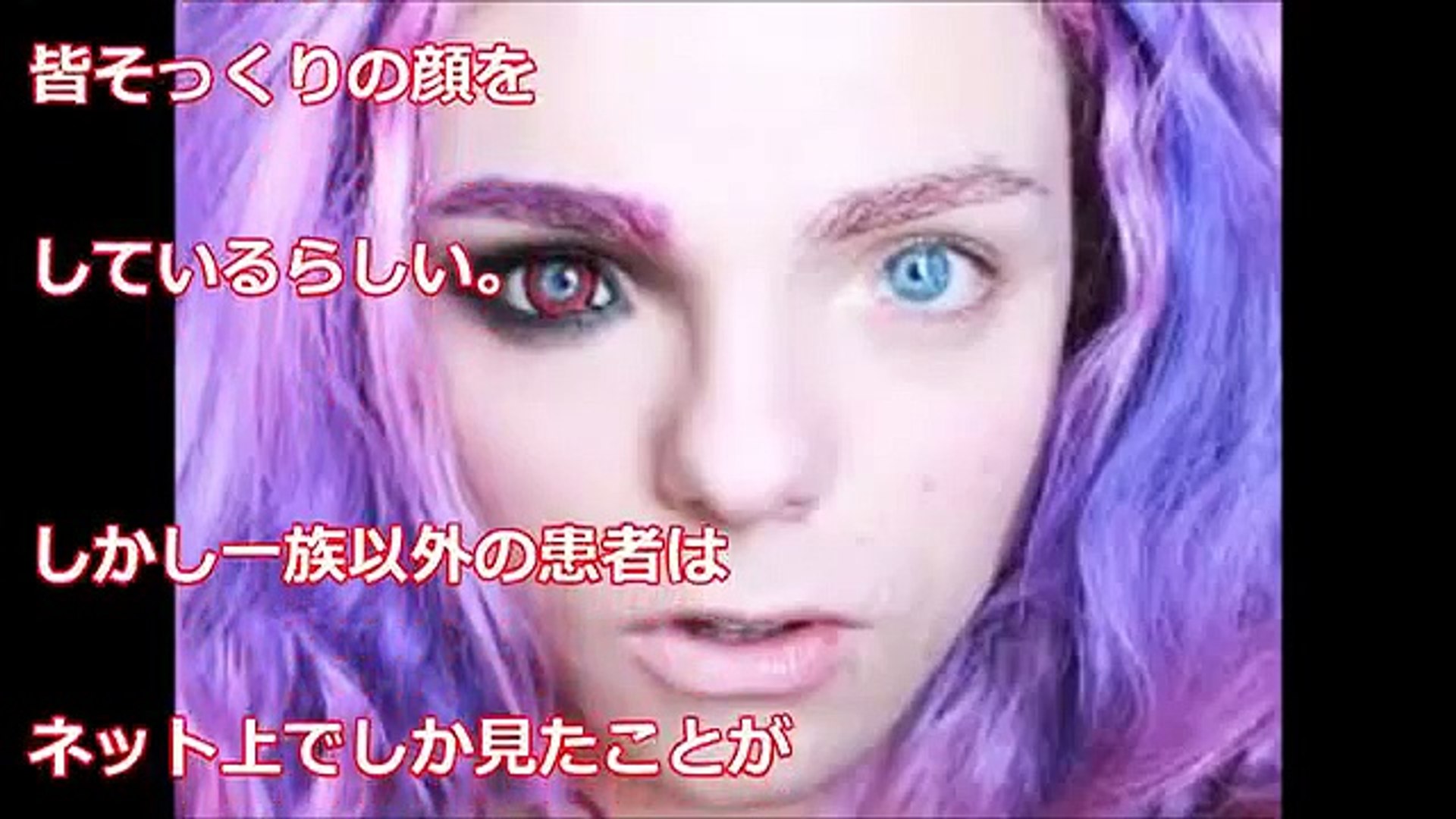 42000人に1人？ワーデンブルグ症候群、何万人、何千人、何百人に1人の疾患で生まれた人たち地球ジャック