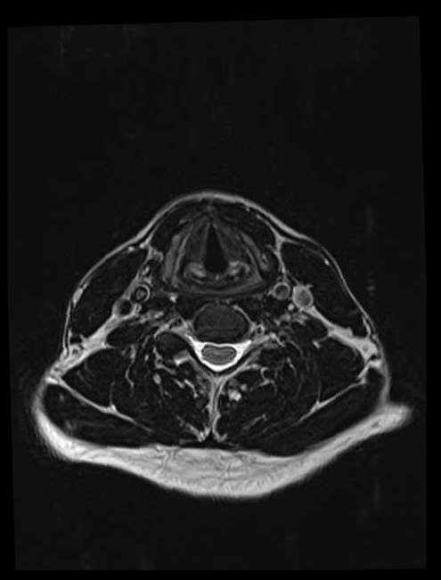 不対性の喉頭軟骨の語呂合わせ!不対性の喉頭軟骨とは~20秒で試験対策!~国試黒本