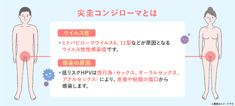 尖圭コンジローマ東京・性感染症内科銀座ヒカリクリニック