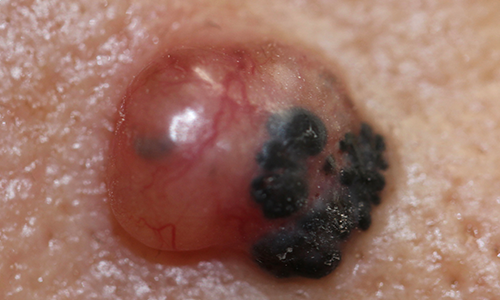 皮ふがん 悪性腫瘍すがも小林皮フ科