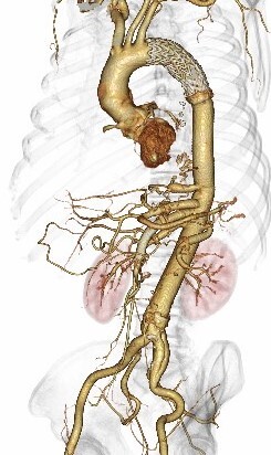 腹部・胸部大動脈瘤治療沖縄 病院医療法人 徳洲会 中部徳洲会病院
