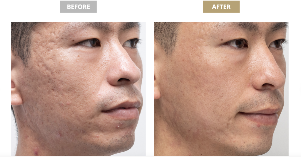 薬剤師が解説 頭皮のできものが痛い時におすすめの市販薬はどれ？9選を紹介 – EPARKくすりの窓口コラムヘルスケア情報