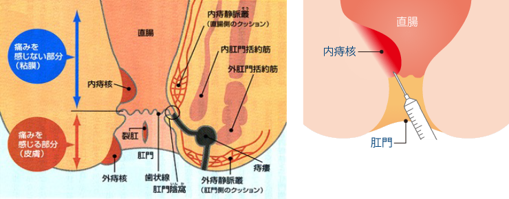 自宅でできる いぼ痔の悪化を防ぐ肛門体操のやり方を紹介大ぢ典ヒサヤ大黒堂
