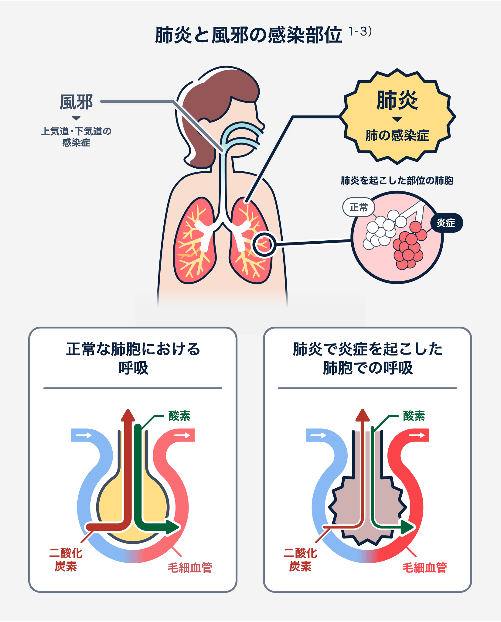 本物の風邪は受診の必要なし まず3症状をチェック - 日本経済新聞