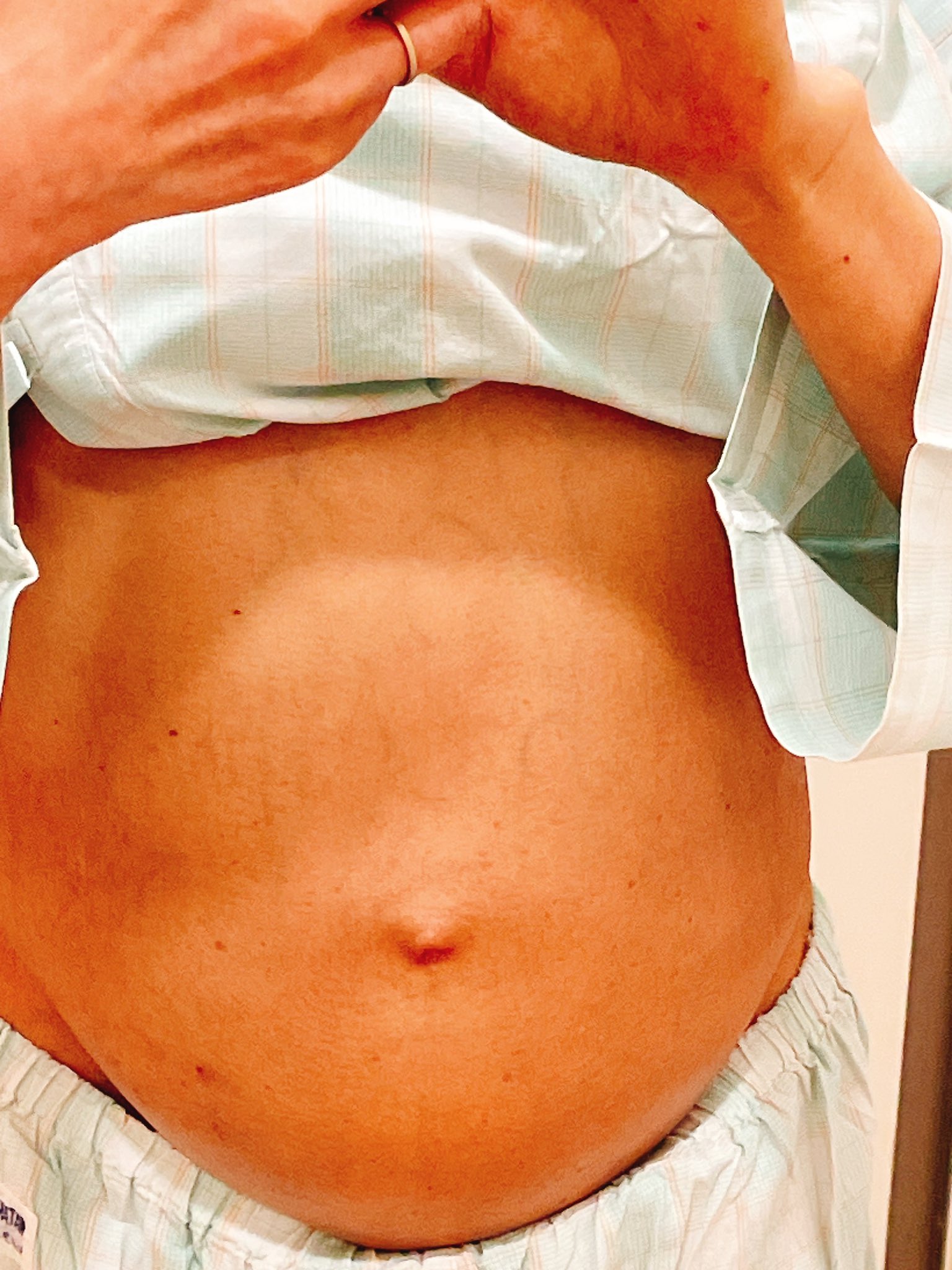 腹膜播種とがん性腹水