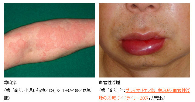 腎・高血圧内科遺伝性血管性浮腫順天堂大学医学部附属順天堂医院