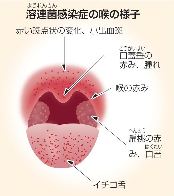 溶連菌感染症の口と舌の症状写真で見る「子どもの病気」 - みやけ内科・循環器科 総合内科のアプローチ