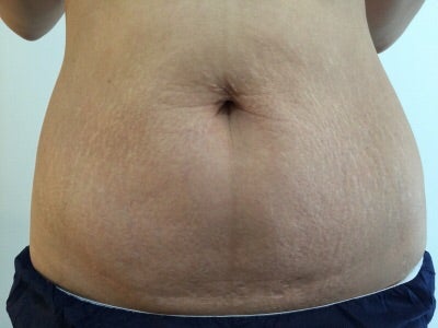 出産後のこのお腹はもう戻らないでしょうか。 - 双子だったこともあ- Yahoo!知恵袋