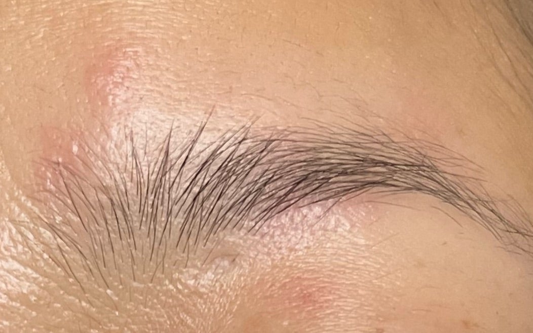 頭皮のフケ・かゆみ・できものの原因と治療港北高田駅前すみれ皮膚科