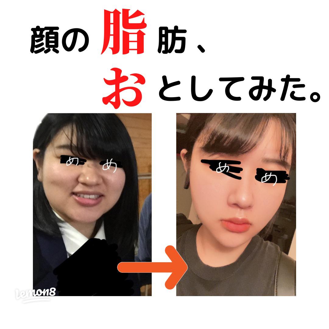 たった1週間で顔痩せ！小顔脂肪吸引の効果と症例写真美容整形クリニックA CLINIC 公式